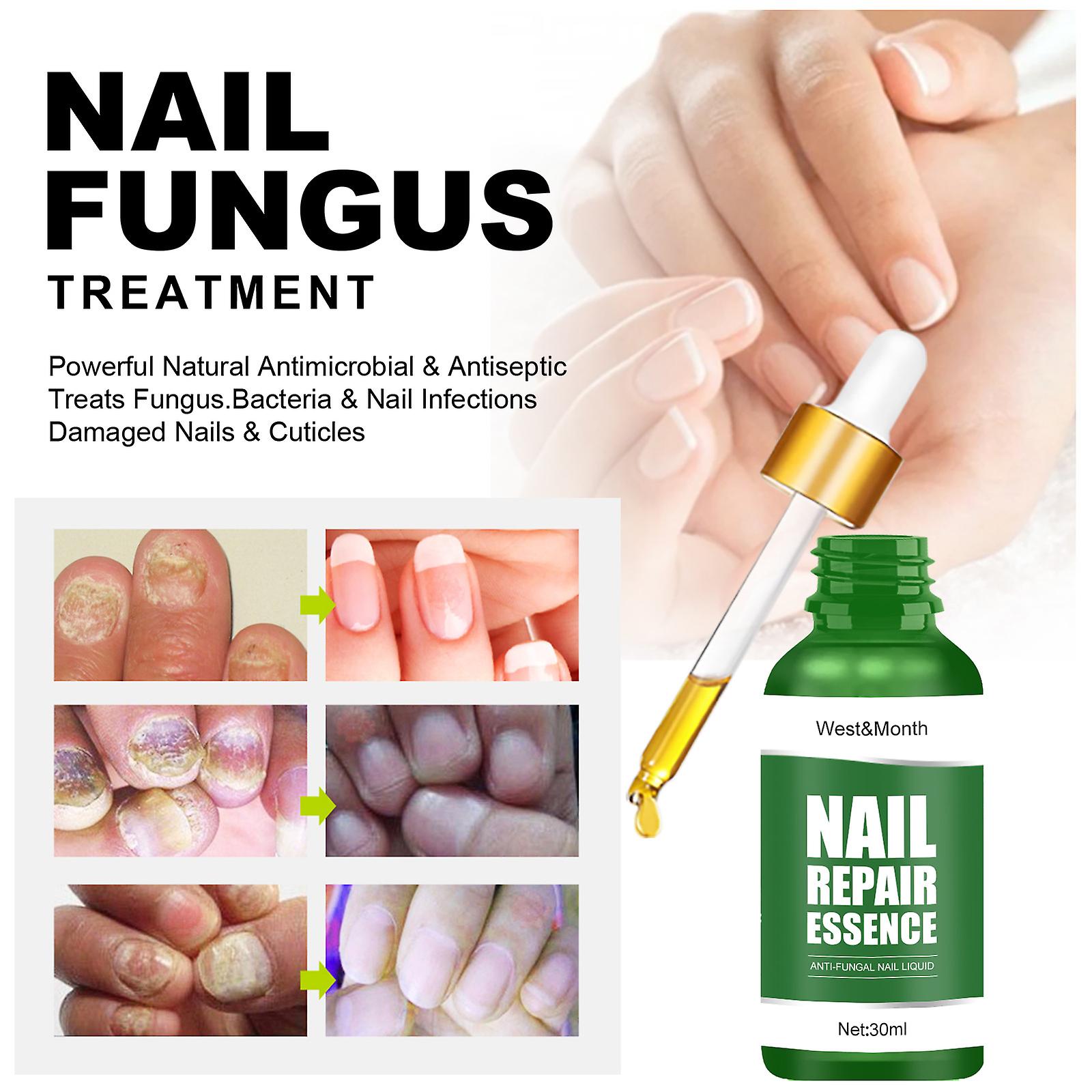 Nail Repair Solution Thickening Of Hands And Feet Brightening Of Nails Repair Of Rotten Nails Nail Nails Removal Of Nail Fungus Infection Cleaning