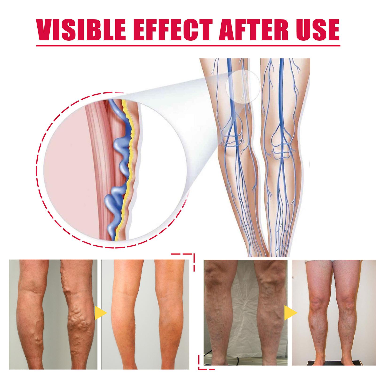 Rose Vein Treatment Oil Leg Massage Varicose Veins Improve Blood Circulation Lymphatic Leg Care