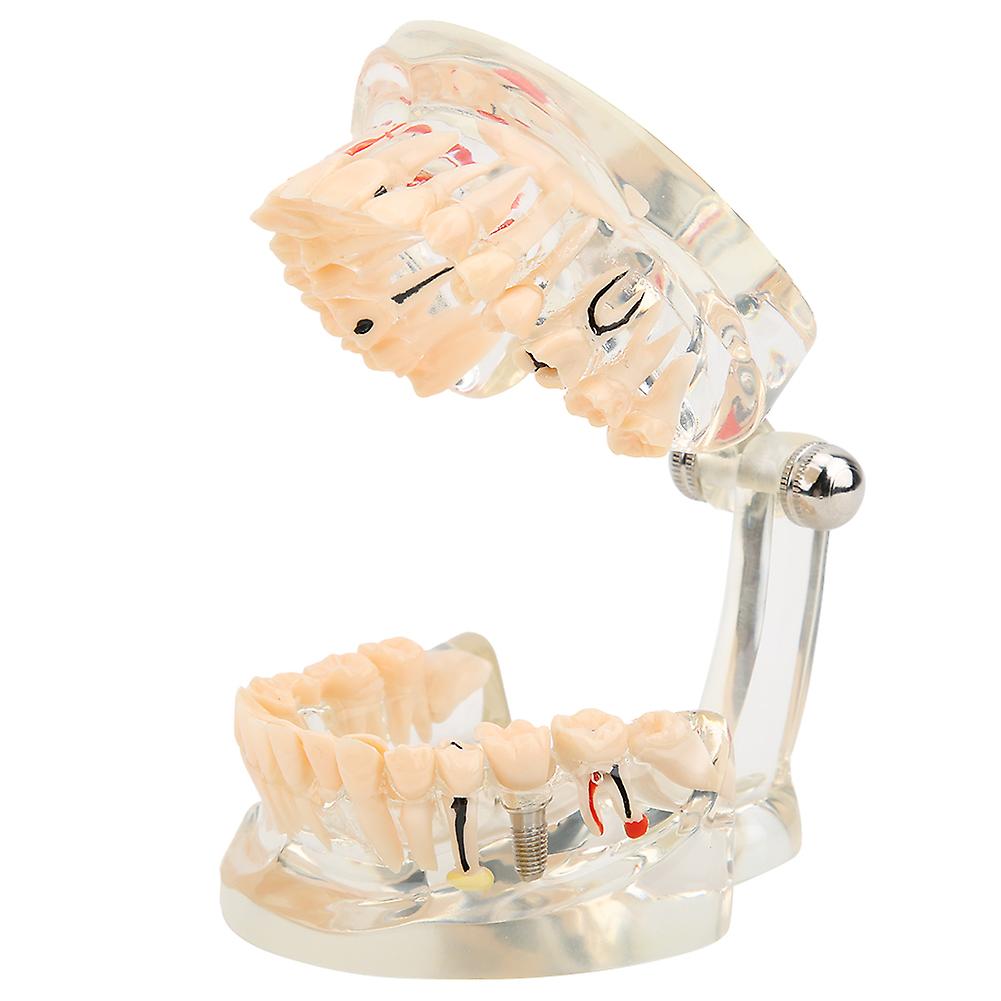 Adult Teeth Pathological Model Dental Implant Model Dental Study Teaching Teeth Model