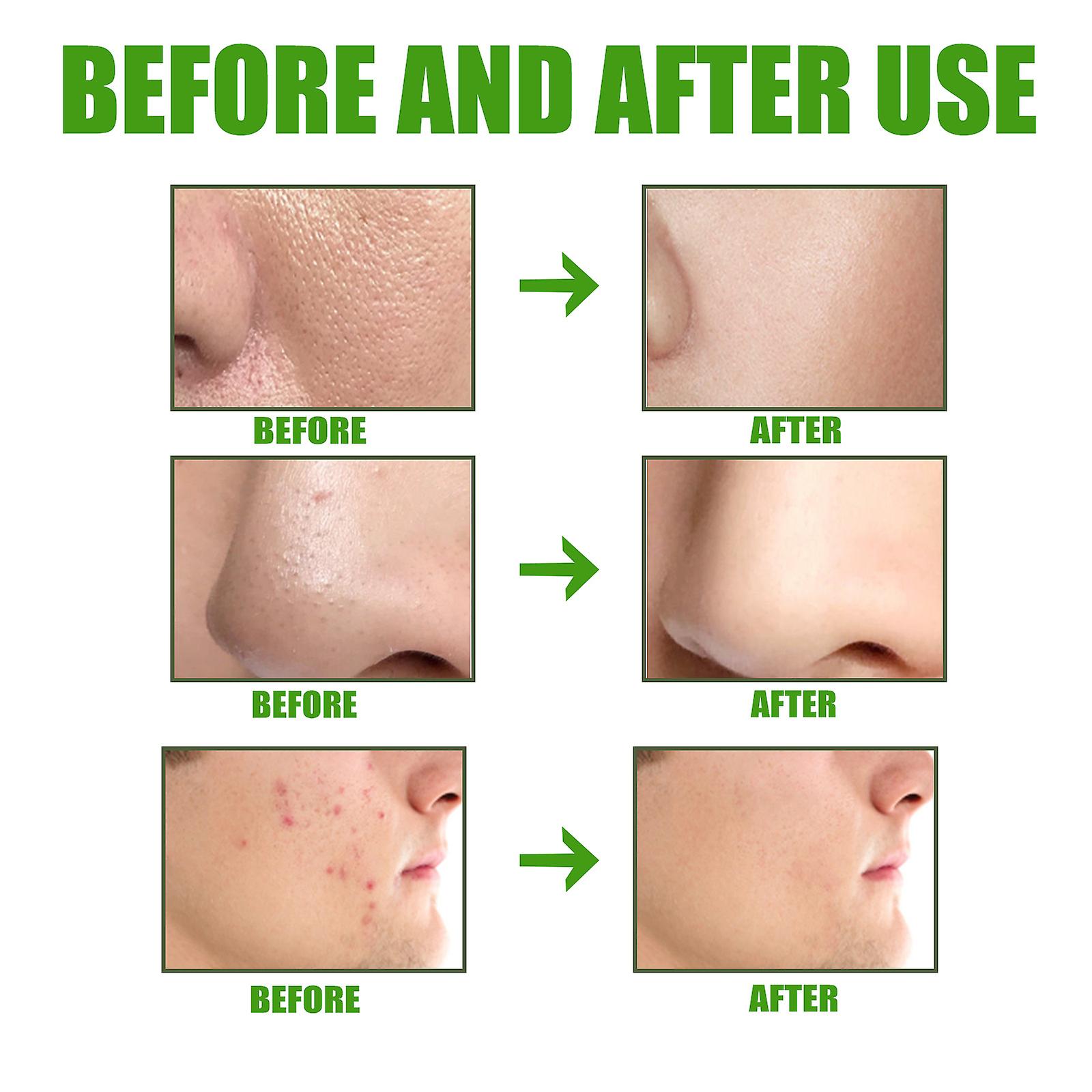 Amino Acids Gently Cleanse Mud Membrane Amino Acids Gently Cleanse Blackheads Shrink Pores And Remove Acne