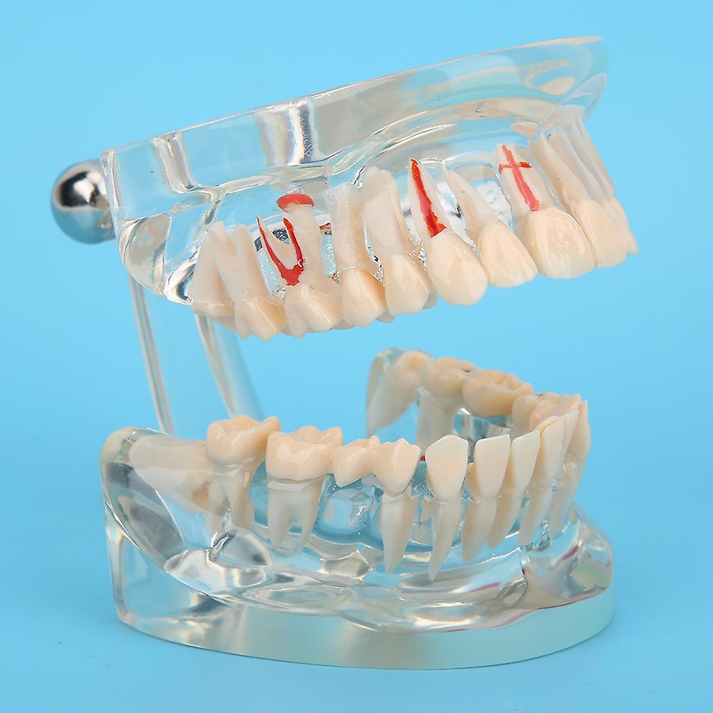 Adult Teeth Pathological Model Dental Implant Model Dental Study Teaching Teeth Model