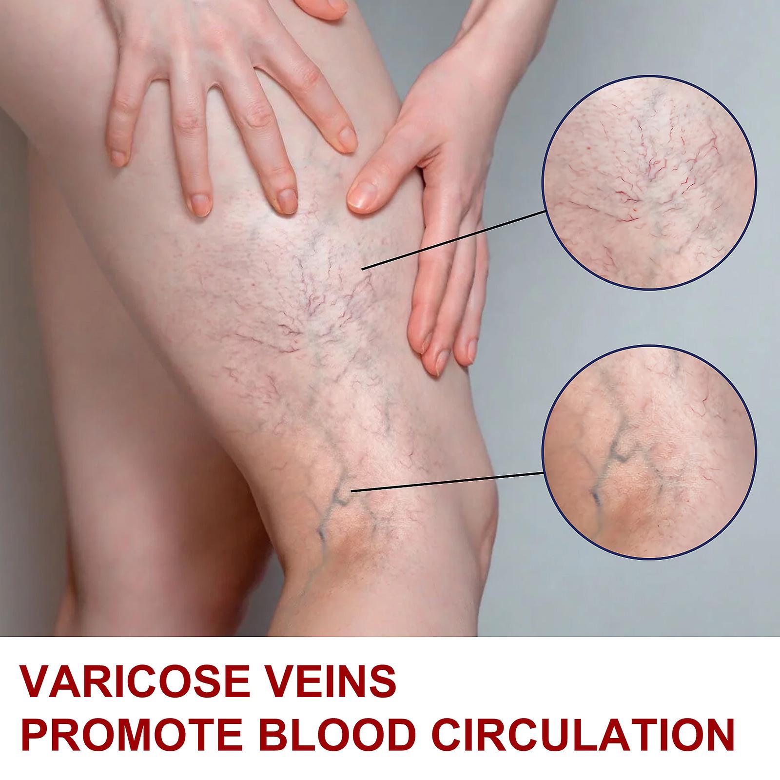 Intravenous Massage Varicose Cream Relieves Bulging Blood Vessels In The Legs Calf Swelling Earthworm Leg Intravenous Massage Cream