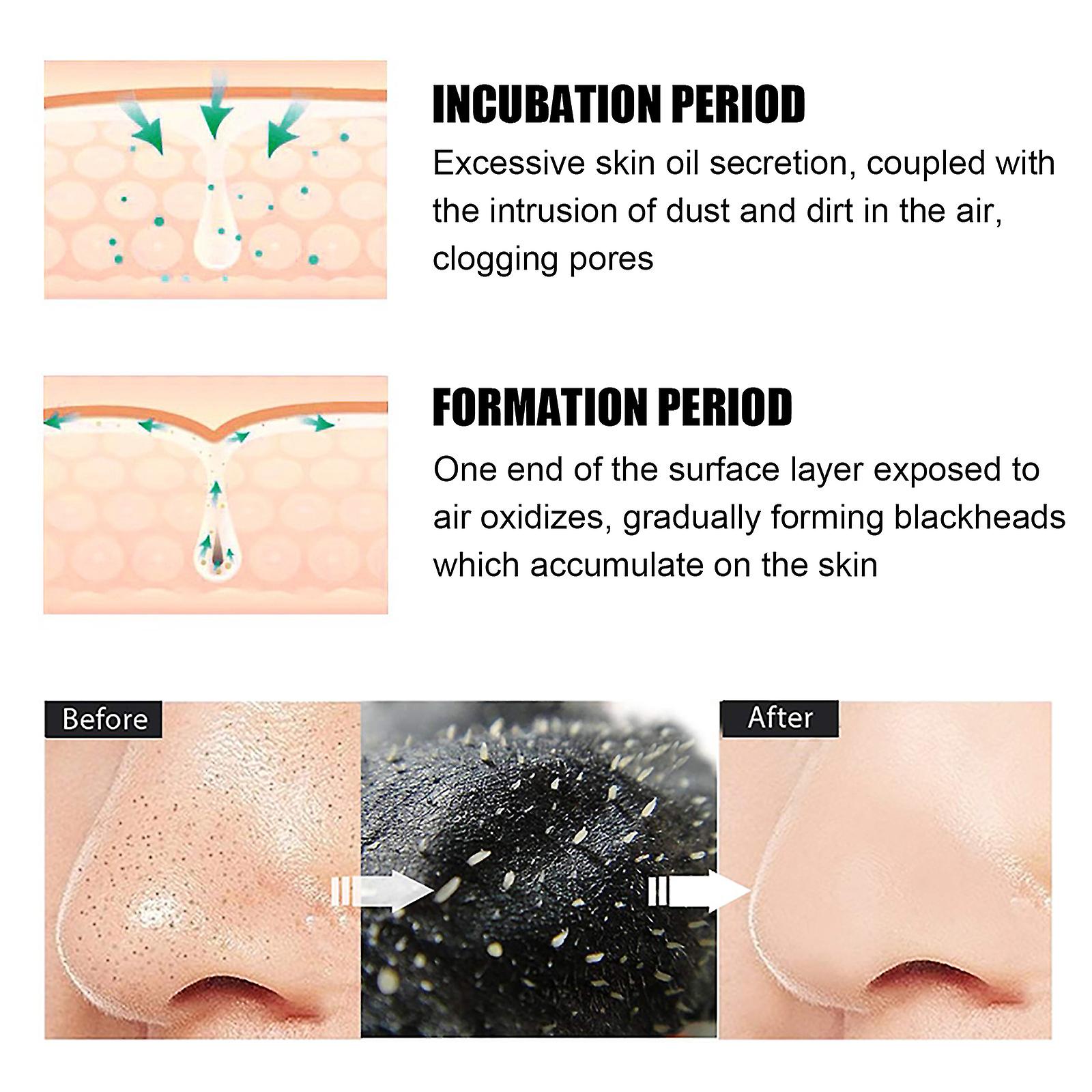 Black Pig Nose Sticker Bamboo Charcoal To Remove Blackheads Nasal Patch Peel Nasal Patch To Remove Acne Set Box To Remove Blackheads