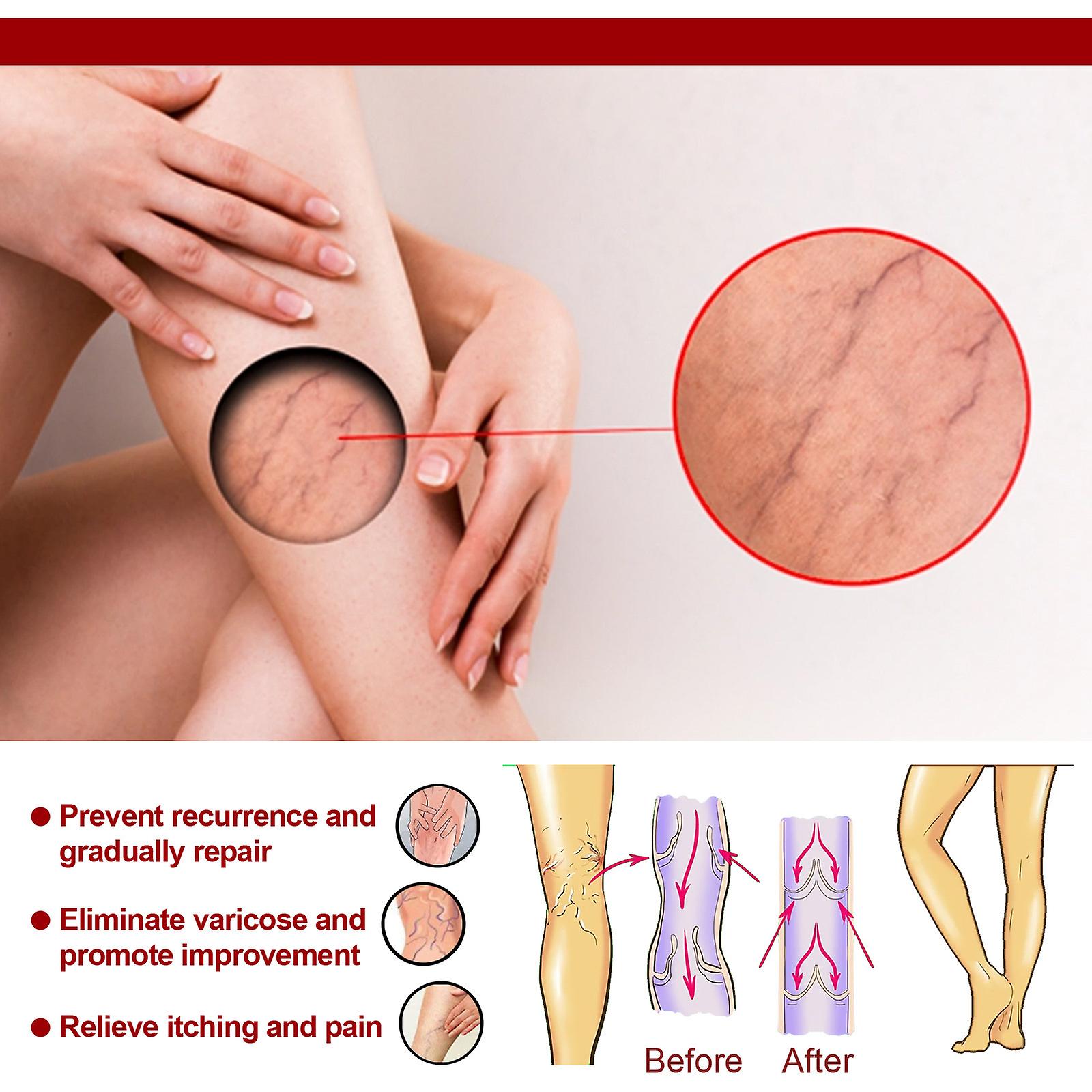 Intravenous Massage Varicose Cream Relieves Bulging Blood Vessels In The Legs Calf Swelling Earthworm Leg Intravenous Massage Cream