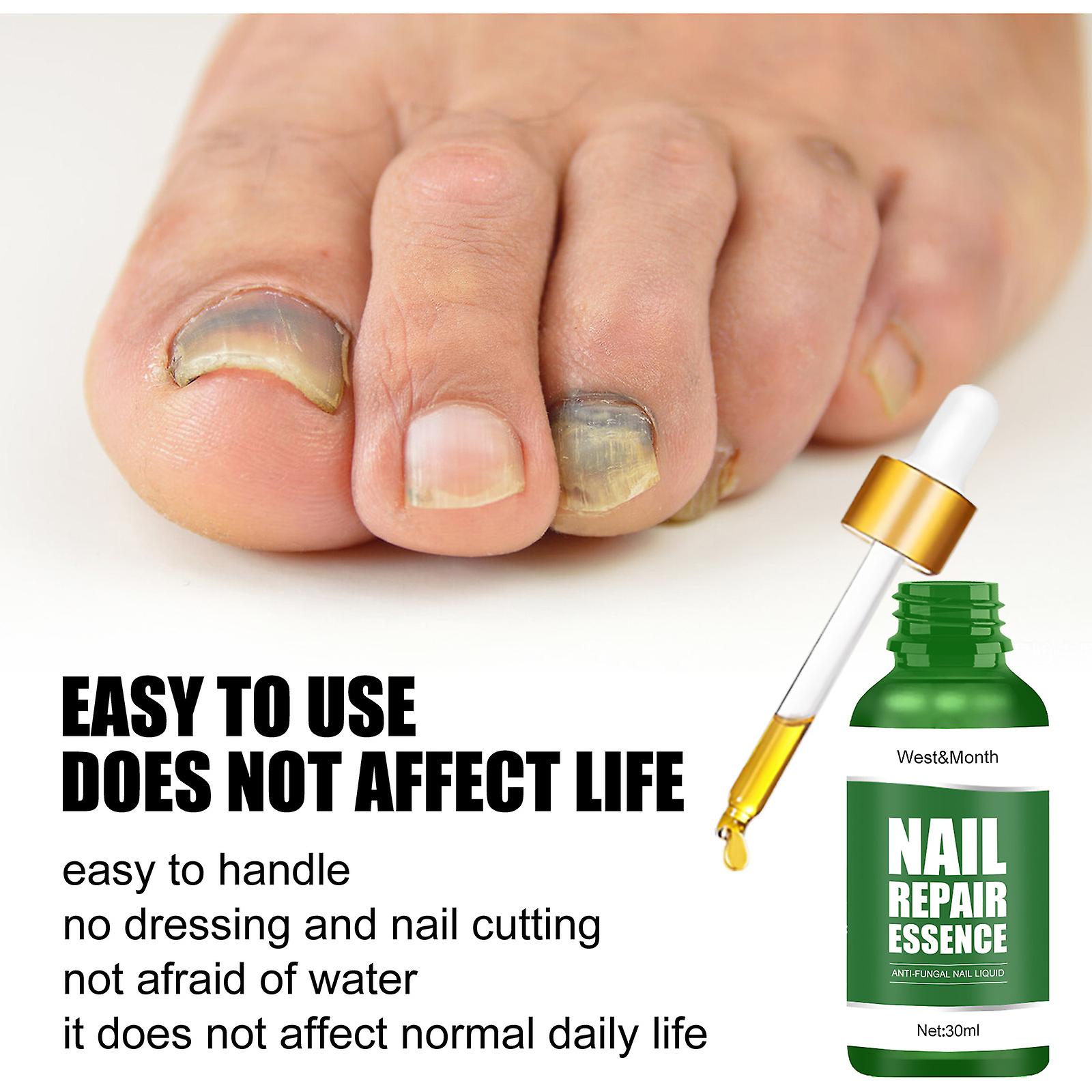 Nail Repair Solution Thickening Of Hands And Feet Brightening Of Nails Repair Of Rotten Nails Nail Nails Removal Of Nail Fungus Infection Cleaning