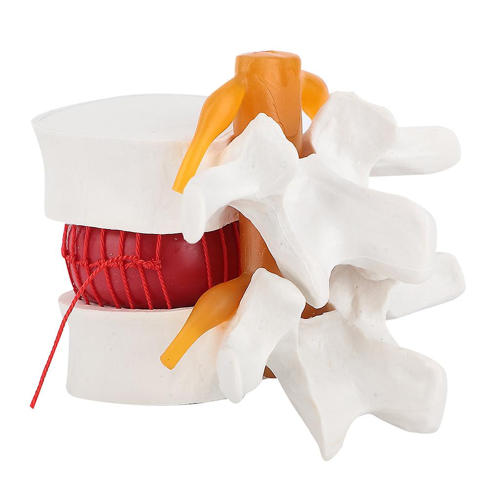 1:1.5 Medical Demonstration Model Of Lumbar Vertebral Spine Human Lumbar Disc Herniation Model