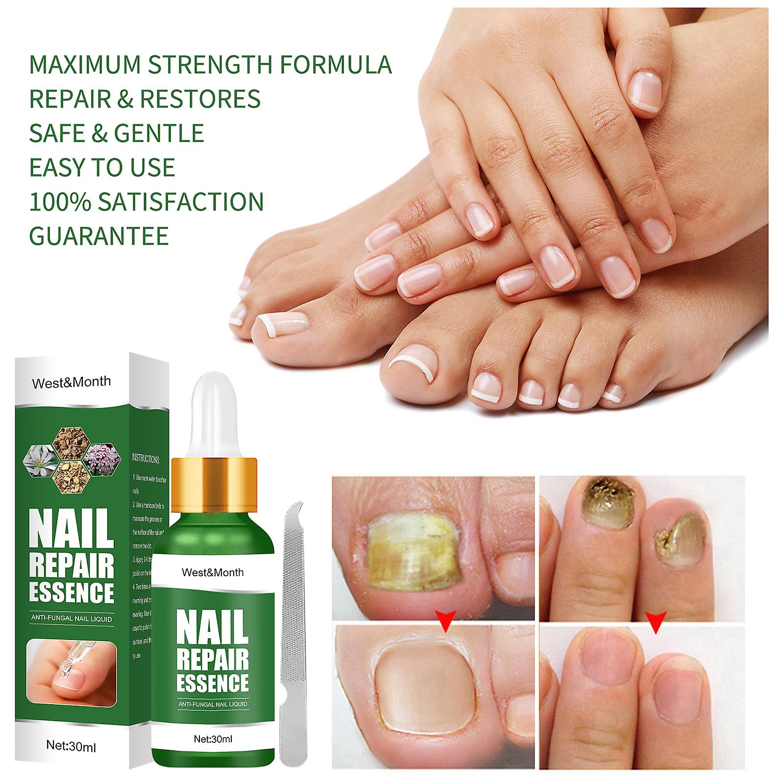 Nail Repair Solution Thickening Of Hands And Feet Brightening Of Nails Repair Of Rotten Nails Nail Nails Removal Of Nail Fungus Infection Cleaning