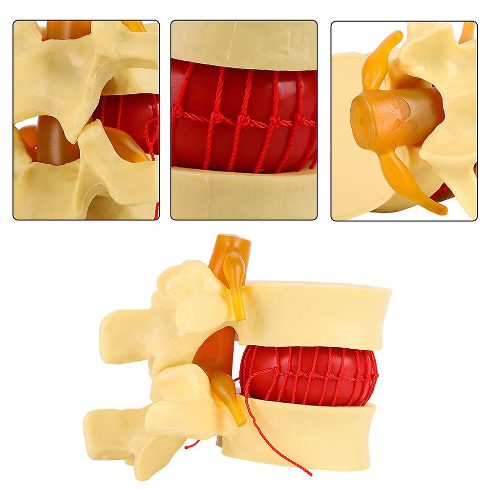 1:1.5 Anatomical Medical Human Spine Lumbar Disc Herniation Demonstration Model For Study Learn