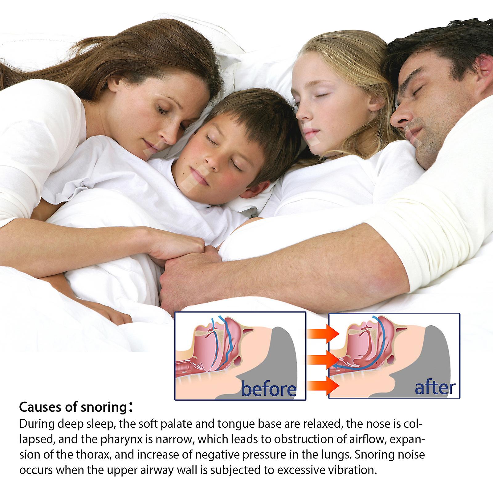 Anti-snoring Tape: Open Mouth Breathing Anti-snoring Anti-snoring Physical Expansion Nasal Patches Anti-snoring Patches