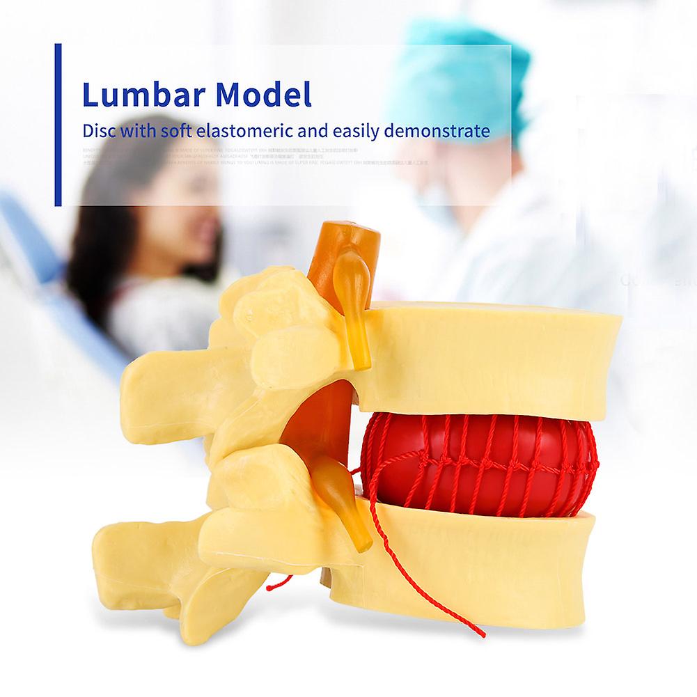 1:1.5 Anatomical Medical Human Spine Lumbar Disc Herniation Demonstration Model For Study Learn