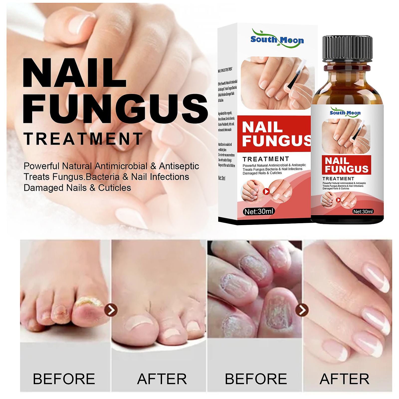 Hand And Foot Nail Repair Solution Nail Fungus Special Treatment Nourishing Smoothing Nails Bright Nail Liquid