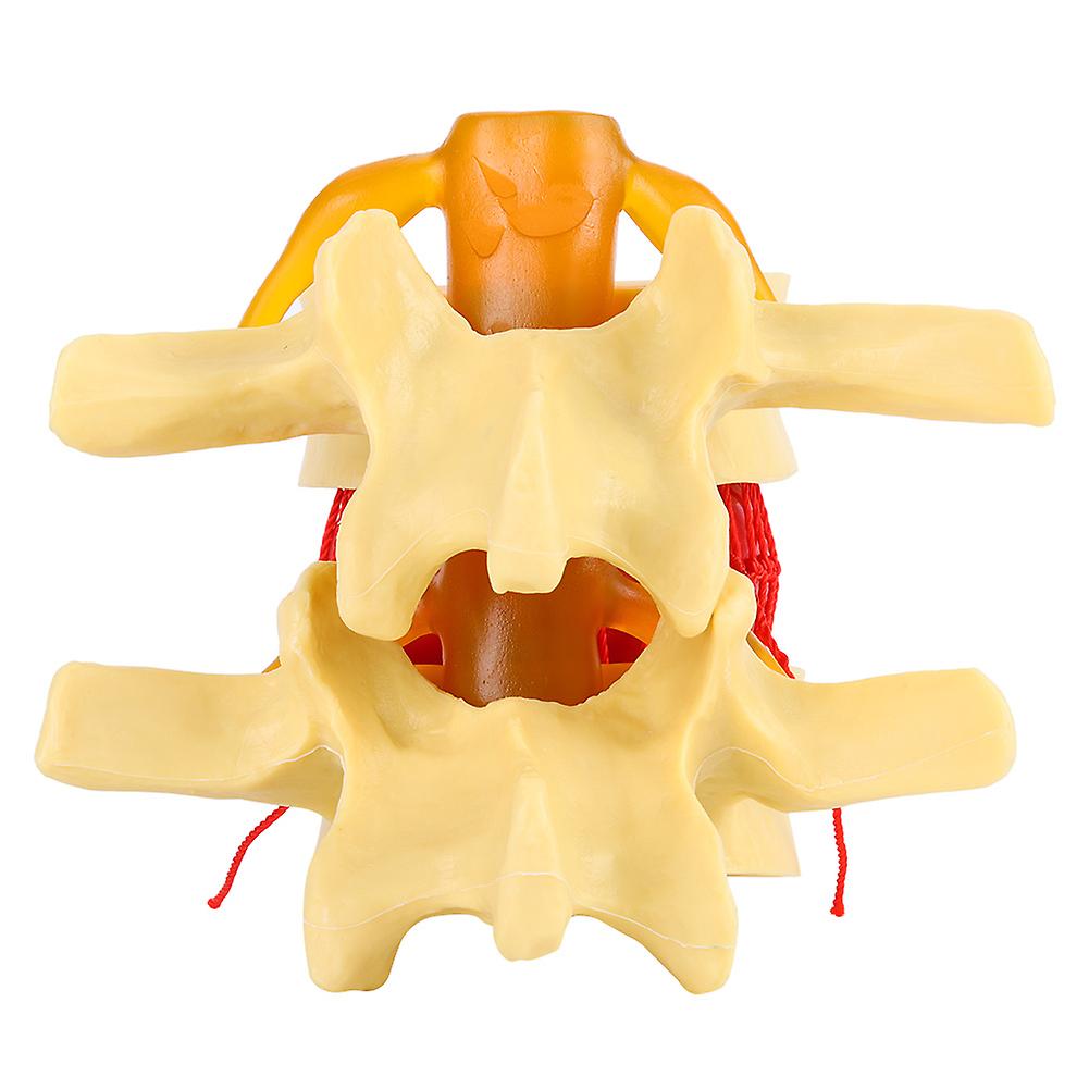 1:1.5 Anatomical Medical Human Spine Lumbar Disc Herniation Demonstration Model For Study Learn