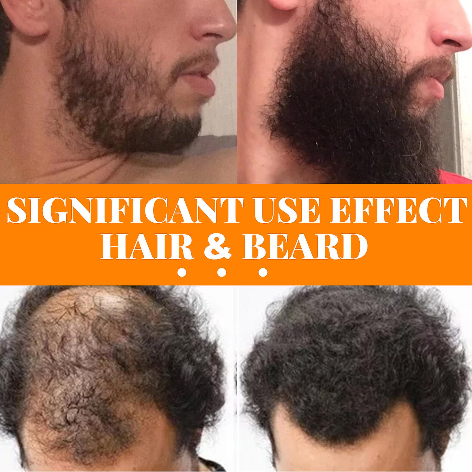 Hair And Beard Growth Serum Beard Hairline Dense Hair To Prevent Nutrient Hair Root Care