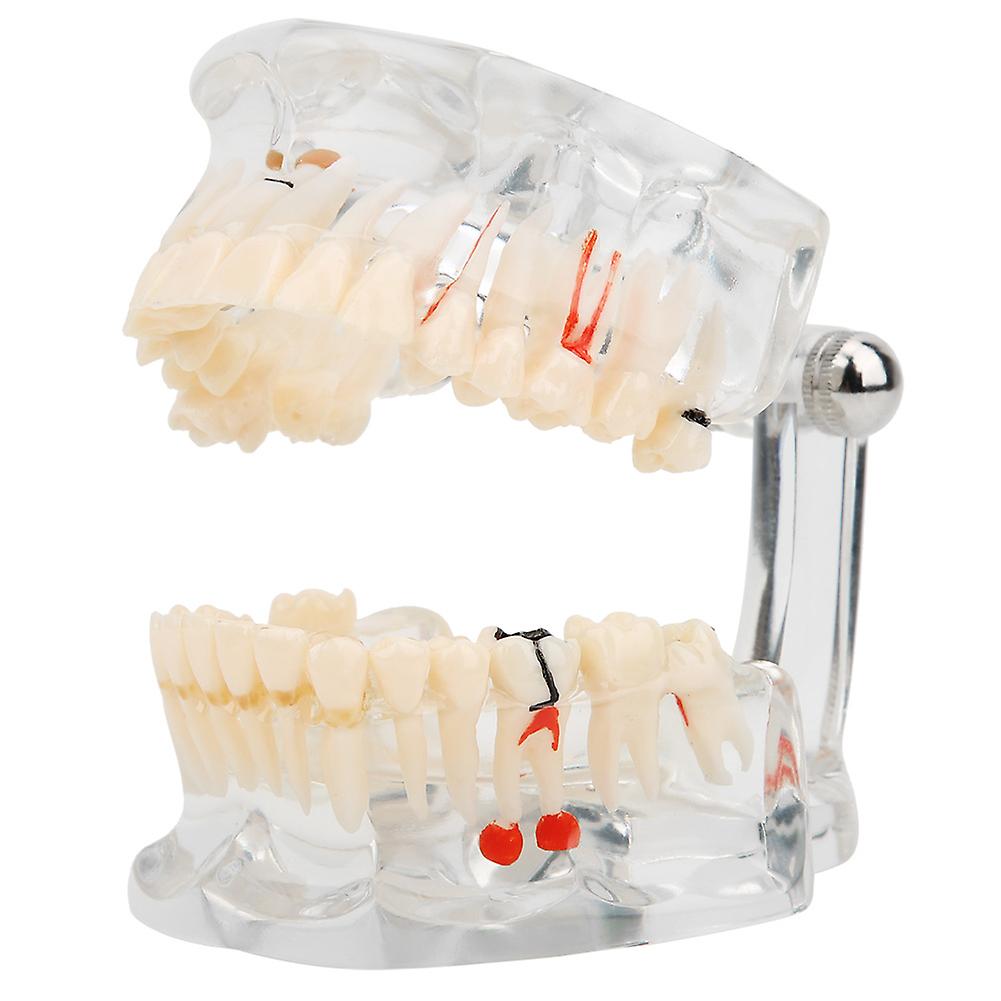 Pathology Model With Missing Tooth Dental Experimental Research Teaching Equipment