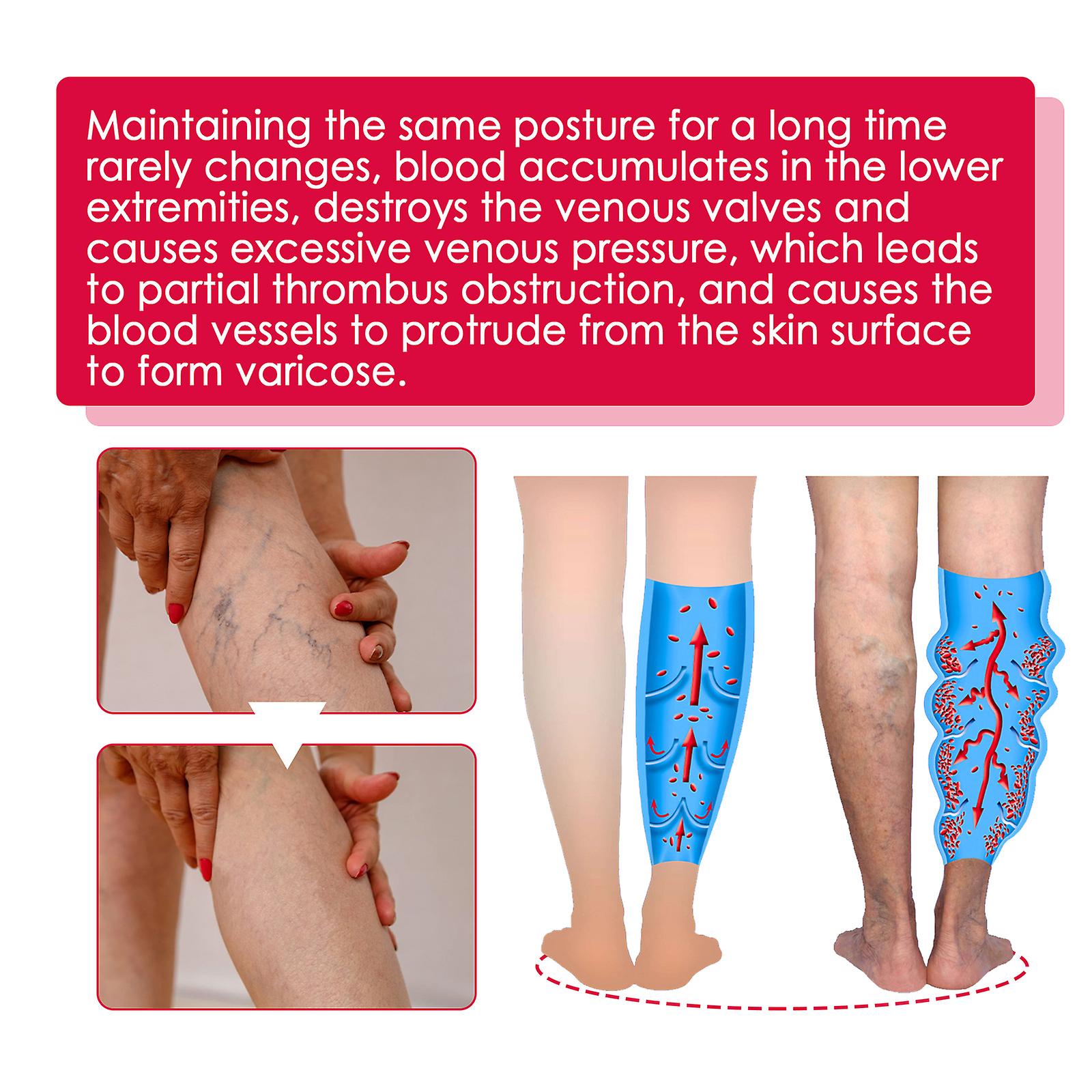 Rose Vein Treatment Oil Leg Massage Varicose Veins Improve Blood Circulation Lymphatic Leg Care