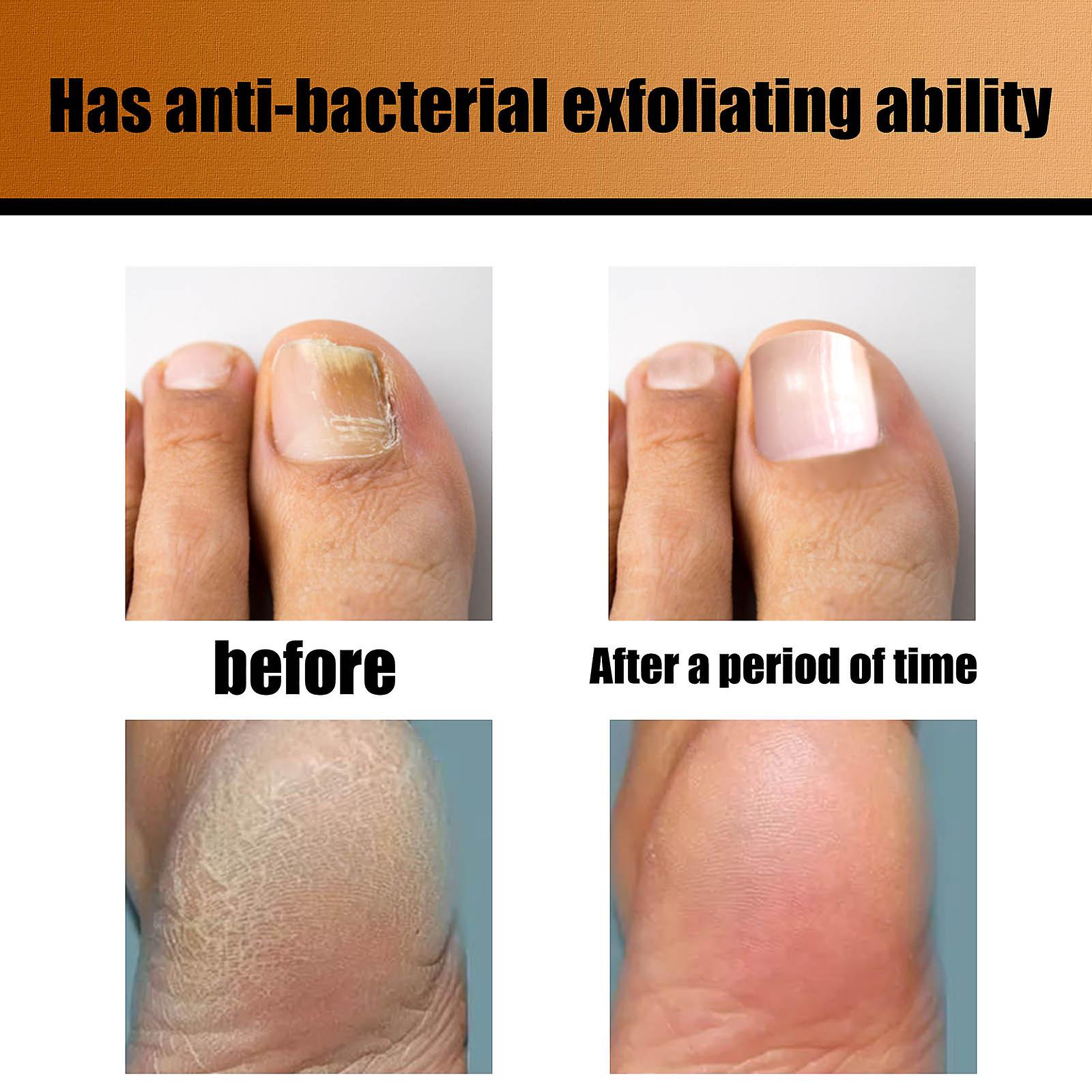 Exfoliating Foot Soak Nail Fungus Foot Soak Pills For Chapped Feet