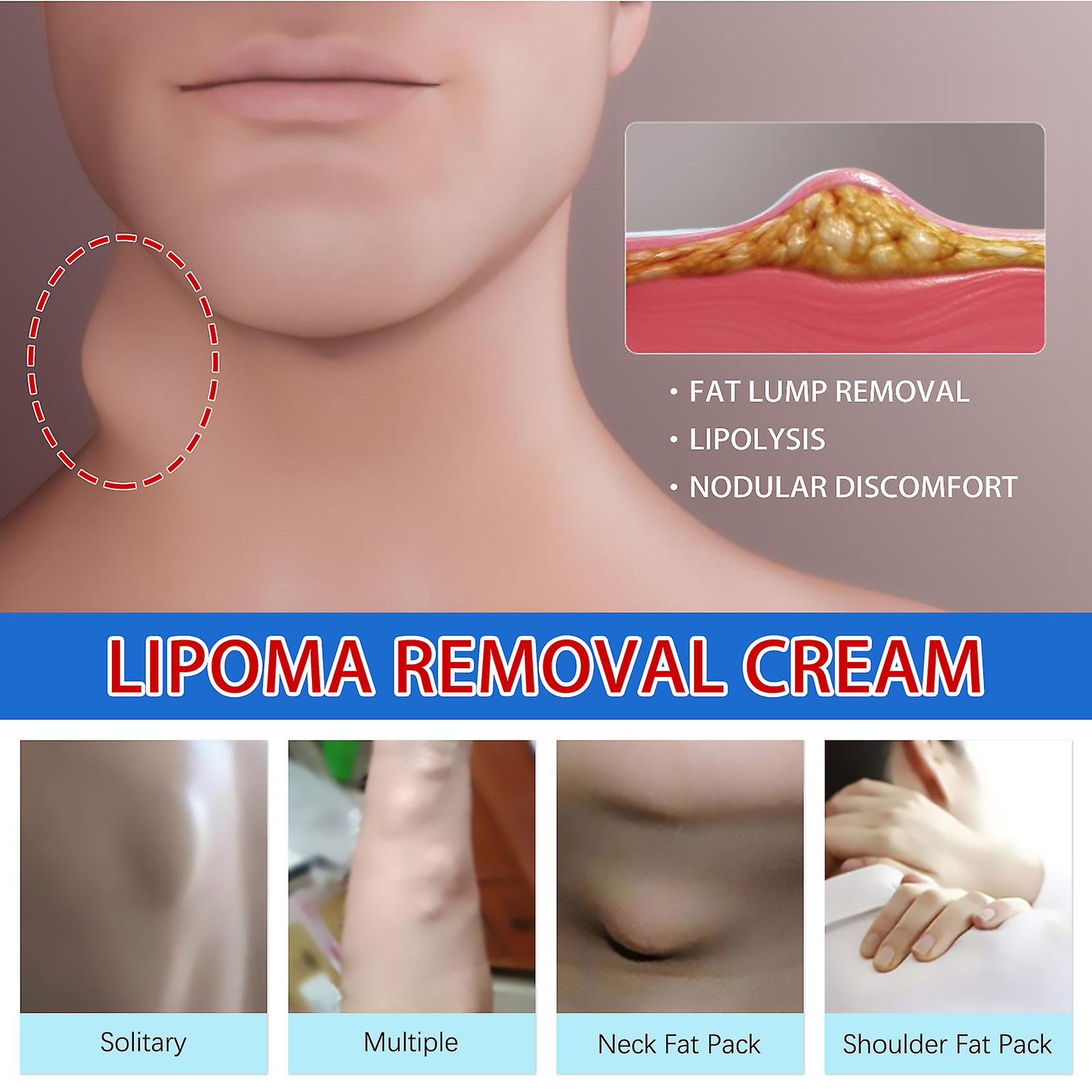 Fat Formation Cream Body Care Relieves Fatty Lumps Tumors Subcutaneous Lumps Unclogging And Eliminating Knots