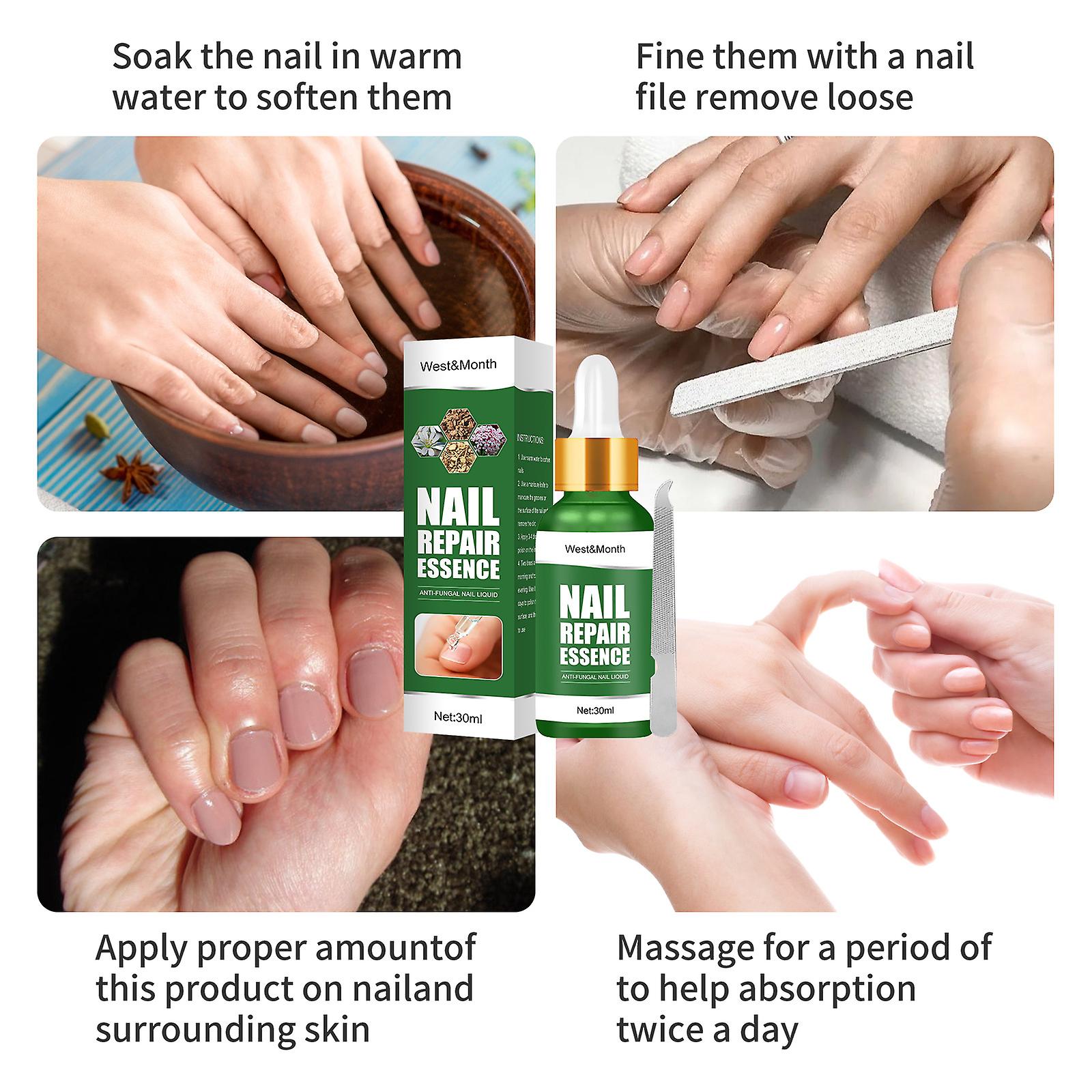 Nail Repair Solution Thickening Of Hands And Feet Brightening Of Nails Repair Of Rotten Nails Nail Nails Removal Of Nail Fungus Infection Cleaning