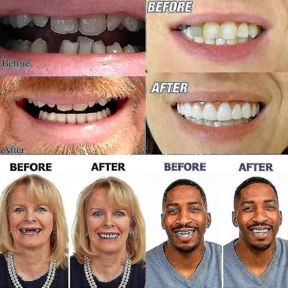 Artificial Teeth Dentures Temporary Quick Dental Prosthesis Top Perfect Smile Veneers， Repair Your T