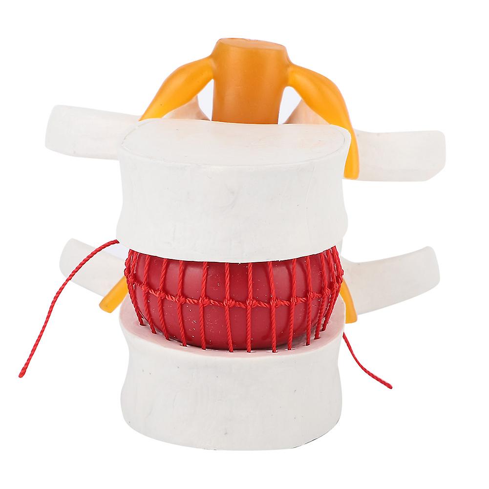 1:1.5 Medical Demonstration Model Of Lumbar Vertebral Spine Human Lumbar Disc Herniation Model