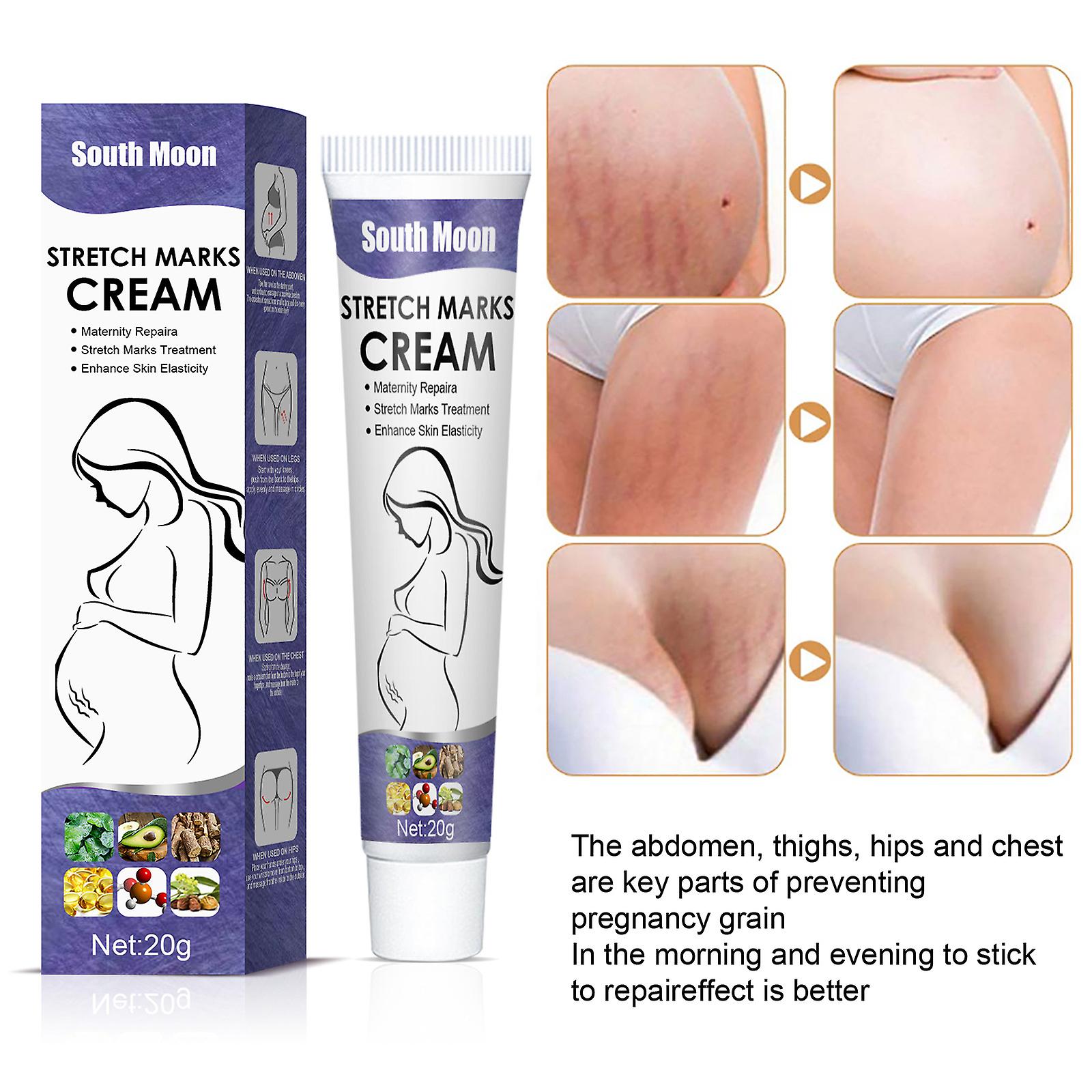 Stretch Mark Repair Cream Postpartum Removal Of Stretch Marks Mommy Cream Lighten Growth Marks Obesity Marks Stretch Marks