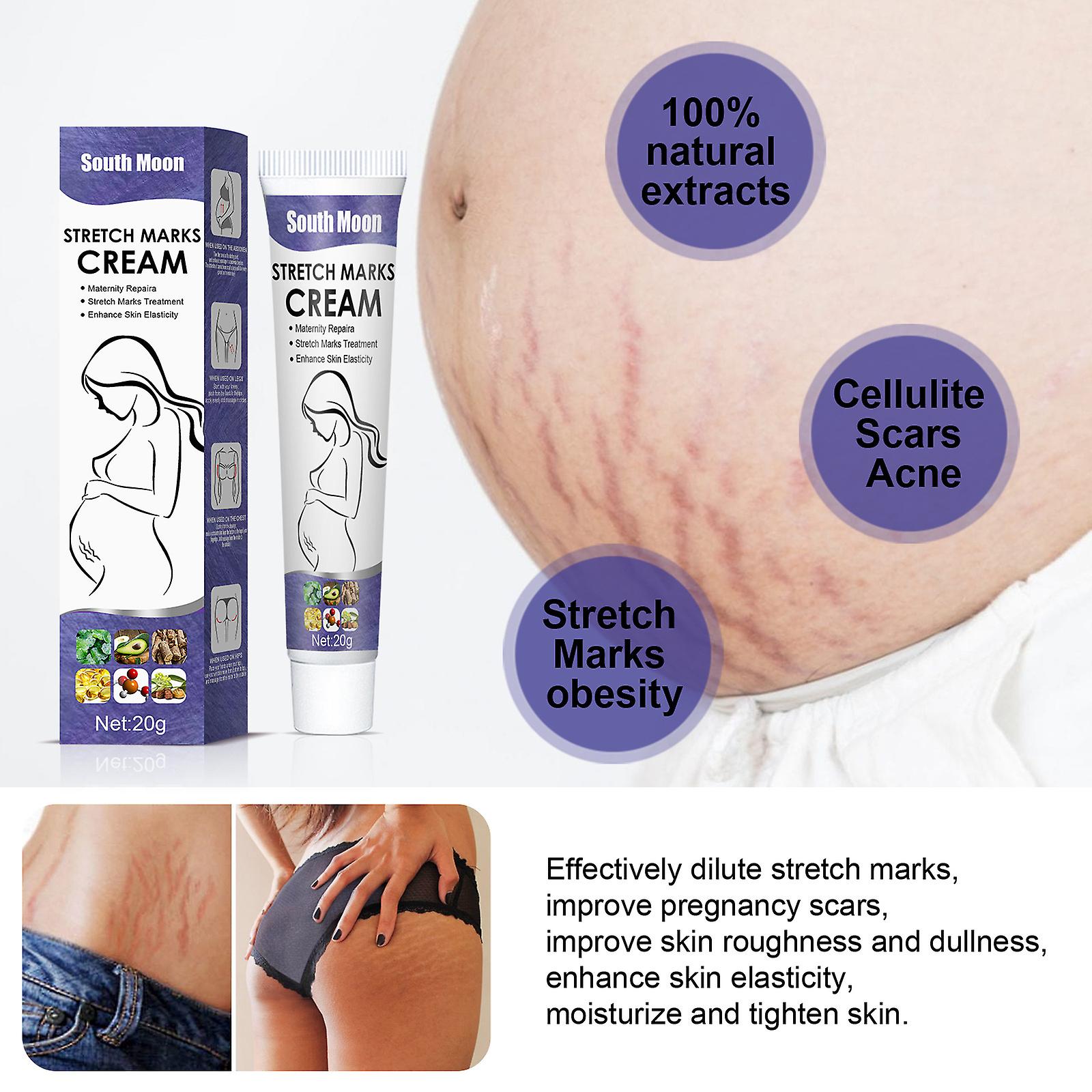 Stretch Mark Repair Cream Postpartum Removal Of Stretch Marks Mommy Cream Lighten Growth Marks Obesity Marks Stretch Marks