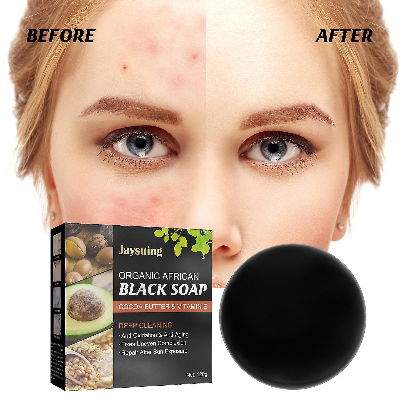 Acne Mite Removal Soap Facial Cleansing Anti-acne Back Cleaning Acne Mites Handmade